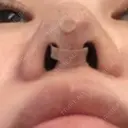 隆鼻術 / 鼻尖形成（切開） / 小鼻縮小（切開） / 軟骨移植 フェアクリニック川口 DAY 357 サムネイル用