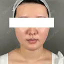 糸リフト / 脂肪吸引（顔） / ジョールファット除去 アリエル美容クリニック 大宮院 DAY 7 サムネイル用