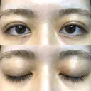 二重埋没 オアシス美容外科 DAY 8 サムネイル用