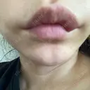 ヒアルロン酸注入（唇） / ボトックス（口角） / ボトックス（人中） ルラ美容クリニック 大宮院 / ルラスキンクリニック 大宮院 DAY 10 サムネイル用