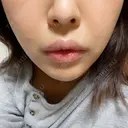 ヒアルロン酸注入（涙袋） / ヒアルロン酸注入（唇） / ボトックス（口角） / ボトックス（人中） HAAB×DREAM BEAUTY CLINIC 東京本院 AFTER サムネイル用