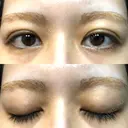 二重埋没 オアシス美容外科 DAY 9 サムネイル用