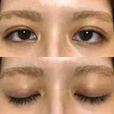 二重埋没 オアシス美容外科 DAY 9 サムネイル用