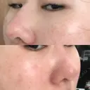 隆鼻術 / 鼻尖形成（切開） / 小鼻縮小（切開） / 軟骨移植 フェアクリニック川口 AFTER サムネイル用