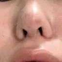 隆鼻術 / 鼻尖形成（切開） / 小鼻縮小（切開） / 軟骨移植 フェアクリニック川口 DAY 478 サムネイル用