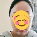 脂肪溶解注射（顔） 聖心美容クリニック 福岡院 AFTER サムネイル用