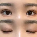 眼瞼下垂（切開） ステラ ロサ クリニック DAY 17 サムネイル用