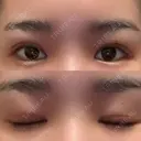 眼瞼下垂（切開） ステラ ロサ クリニック DAY 18 サムネイル用