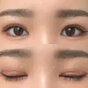 眼瞼下垂（切開） ステラ ロサ クリニック DAY 19 サムネイル用