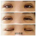 二重切開 / 上まぶたの脂肪取り 札幌ル・トロワ ビューティクリニックVogue DAY 5 サムネイル用