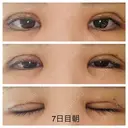 二重切開 / 上まぶたの脂肪取り 札幌ル・トロワ ビューティクリニックVogue DAY 7 サムネイル用