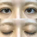 二重埋没 オアシス美容外科 DAY 13 サムネイル用