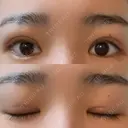 眼瞼下垂（切開） ステラ ロサ クリニック DAY 20 サムネイル用