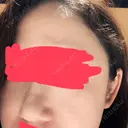 ヒアルロン酸注入（鼻） 東京美容外科 銀座院 DAY 0 サムネイル用