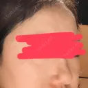 ヒアルロン酸注入（鼻） 東京美容外科 銀座院 DAY 0 サムネイル用