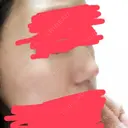 ヒアルロン酸注入（鼻） 東京美容外科 銀座院 DAY 1 サムネイル用