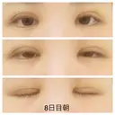 二重切開 / 上まぶたの脂肪取り 札幌ル・トロワ ビューティクリニックVogue DAY 8 サムネイル用