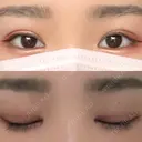 眼瞼下垂（切開） ステラ ロサ クリニック DAY 22 サムネイル用