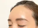 ヒアルロン酸注入（額） / ヒアルロン酸注入（こめかみ） ハナビューティークリニック DAY 1 サムネイル用