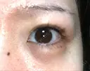 ヒアルロン酸注入（涙袋） 渋谷美容外科クリニック 新宿院 DAY 4 サムネイル用