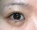 ヒアルロン酸注入（涙袋） 渋谷美容外科クリニック 新宿院 DAY 4 サムネイル用