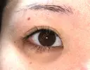 ヒアルロン酸注入（涙袋） 渋谷美容外科クリニック 新宿院 DAY 5 サムネイル用