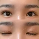 眼瞼下垂（切開） ステラ ロサ クリニック DAY 26 サムネイル用