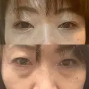 下まぶたの脂肪取り 東郷美容形成外科　福岡 DAY 28 サムネイル用