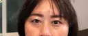 下まぶたの脂肪取り / ボトックス（目尻） TCB東京中央美容外科 町田院 AFTER サムネイル用