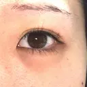 ヒアルロン酸注入（涙袋） 渋谷美容外科クリニック 新宿院 DAY 6 サムネイル用