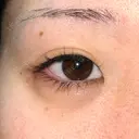 ヒアルロン酸注入（涙袋） 渋谷美容外科クリニック 新宿院 DAY 6 サムネイル用
