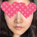 セットバック 大塚美容形成外科・歯科 大塚本院 DAY 58 サムネイル用