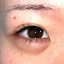 ヒアルロン酸注入（涙袋） 渋谷美容外科クリニック 新宿院 AFTER サムネイル用