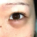 ヒアルロン酸注入（涙袋） 渋谷美容外科クリニック 新宿院 DAY 9 サムネイル用