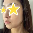 糸リフト 湘南美容クリニック 宇都宮院 DAY 58 サムネイル用