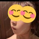 糸リフト / バッカルファット除去 / 脂肪吸引（顔） / ボトックス（エラ・小顔） アリエル美容クリニック 大宮院 DAY 6 サムネイル用