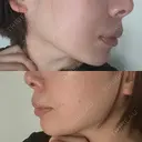 ヒアルロン酸注入（あご） 東京イセアクリニック AFTER サムネイル用