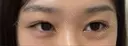 ヒアルロン酸注入（涙袋） Wクリニック 梅田院 AFTER サムネイル用