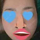 ヴェルヴェットスキン アリエル美容クリニック 大宮院 AFTER サムネイル用