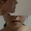 骨切り（あご） / 脂肪吸引（顔） / その他（輪郭） 銀座マイアミ美容外科 AFTER サムネイル用