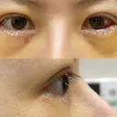 二重切開 / 目尻切開 / 上まぶたの脂肪取り / タレ目形成・グラマラスライン（切開） LIKI CLINIC KOBE DAY 7 サムネイル用