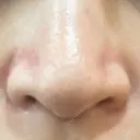 毛穴洗浄（ハイドラフェイシャルなど） STARS CLINIC AFTER サムネイル用