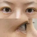 二重切開 / 目尻切開 / 上まぶたの脂肪取り / タレ目形成・グラマラスライン（切開） LIKI CLINIC KOBE DAY 30 サムネイル用