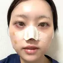 鼻尖形成（切開） / 軟骨移植 / ヒアルロン酸注入（涙袋） / ヒアルロン酸注入（唇） / ボトックス（口角） / ヒアルロン酸注入（額） 東京シンデレラ美容外科 池袋院 DAY 1 サムネイル用