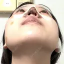 鼻尖形成（切開） / 軟骨移植 / ヒアルロン酸注入（涙袋） / ヒアルロン酸注入（唇） / ボトックス（口角） / ヒアルロン酸注入（額） 東京シンデレラ美容外科 池袋院 DAY 1 サムネイル用