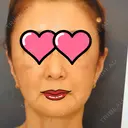 脂肪吸引（顔） / 脂肪注入（額） / 切開リフト 札幌ル・トロワ ビューティクリニックVogue AFTER サムネイル用