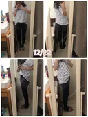 脂肪吸引（脚） / 脂肪吸引（お尻） ヨンセスリムライン DAY 72 サムネイル用