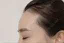 ヒアルロン酸注入（額） / ヒアルロン酸注入（こめかみ） ハナビューティークリニック AFTER サムネイル用