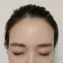 ヒアルロン酸注入（額） / ヒアルロン酸注入（こめかみ） ハナビューティークリニック DAY 12 サムネイル用