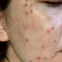 ほくろ・いぼ切除（肌） / シミ取りレーザー Jスキンクリニック 【J-SKIN clinic】 DAY 0 サムネイル用